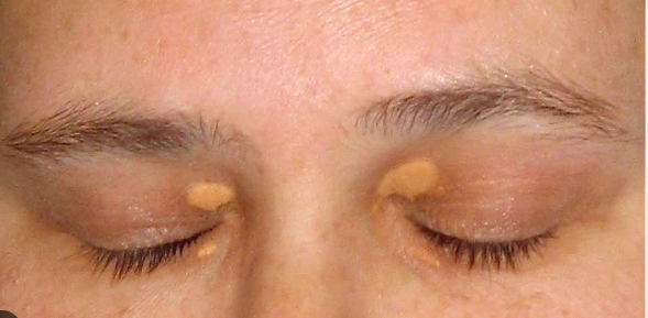 Xanthelasma Plaques of cholesterol deposited over the eyelids
