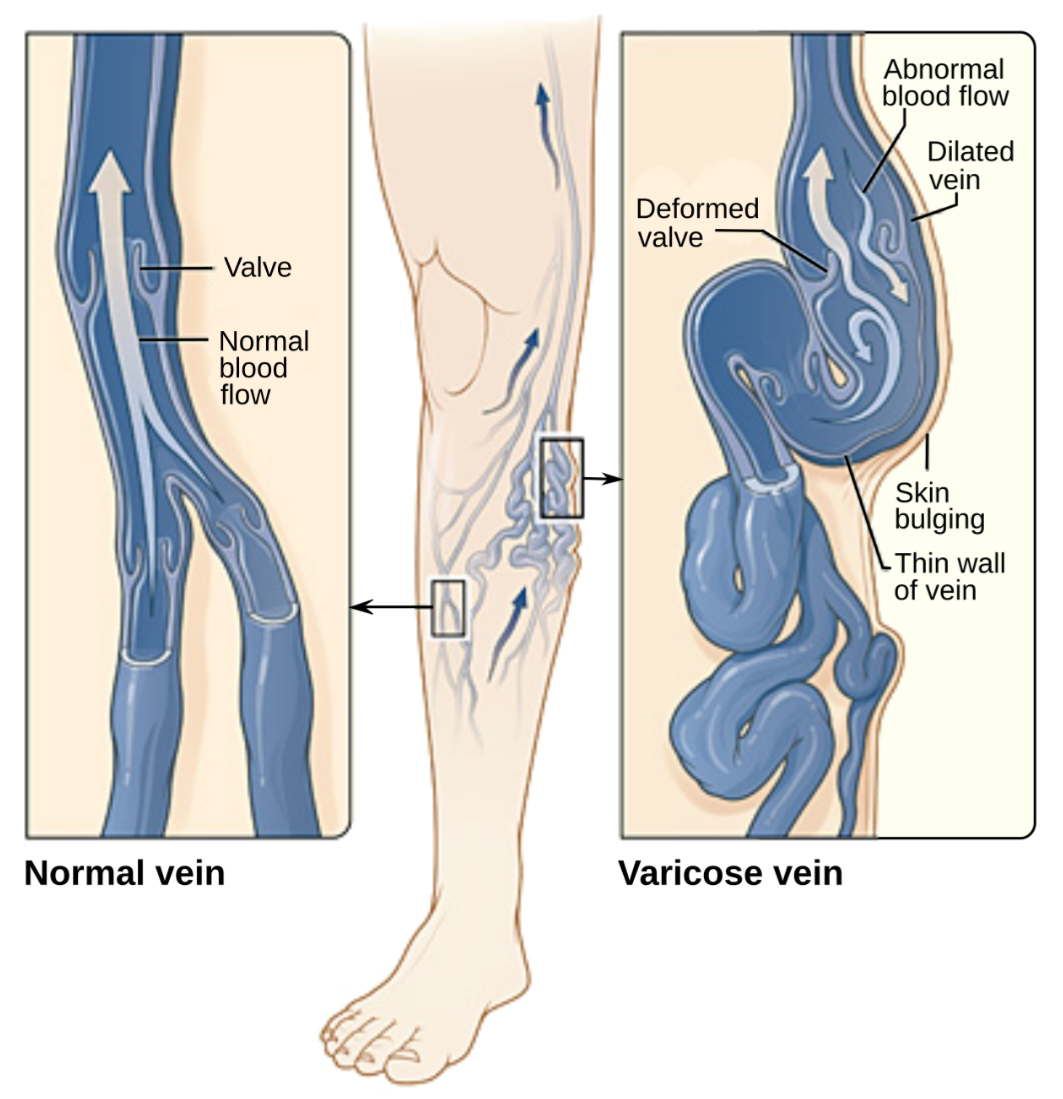 Vericose Veins Causes and Treatment 