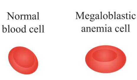 Pernicious anemia